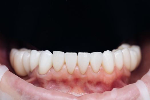 Veneers after fixation. Natural color. Cosmetic dentistry veneers. Modern dental equipment and installation procedure of veneers in dental clinic.