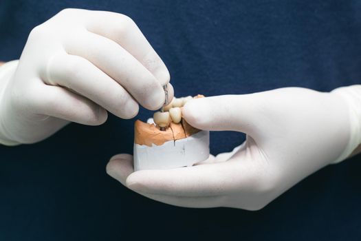 Ceramic teeth with the implant on a plaster model. Prosthetics on dental implants. Concept of orthopedic dentistry. Ceramic bridge on implants. Dentist's hand holds a plaster jaw with dental abutments