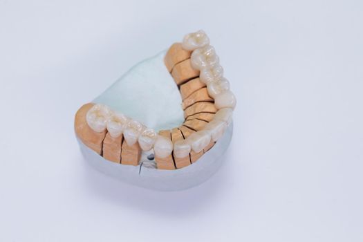 Metal free ceramic dental crowns. Close-up ceramic crowns veneers on a gypsum model. Illuminated glossy look and natural translucency, effect for hollywood smile makeover.