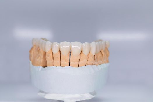 Ceramic tooth crown on plaster model. Finished new ceramic bridge on plaster model, frontal view. Dental veneers are lying on a wite background in the laboratory.