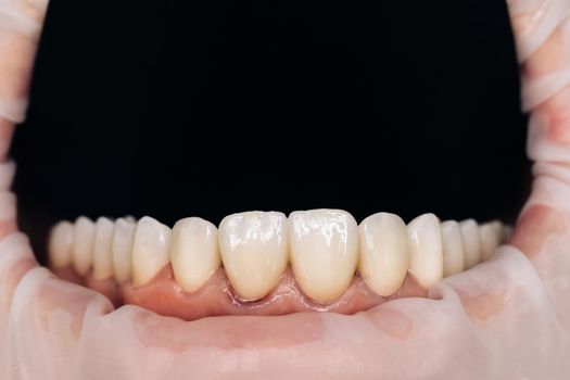 Closeup photo with zirconium artificial teeth. Zirconium crowns. Dental health care. Ceramic zirconium in final version. Staining and glazing. Precision design and high quality materials.