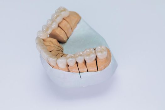 Close-up on plaster model of artificial jaw with veneers on the wite background. Concept of aesthetic dentistry and design of veneers