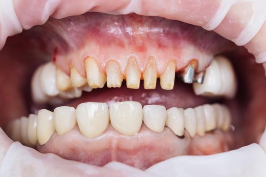 Teeth during dental treatment. Close-up. Dentistry. Patient at the dentist office. Female teeth macro zirconium. Closeup photo with zirconium artificial teeth. Zirconia bridge with porcelain