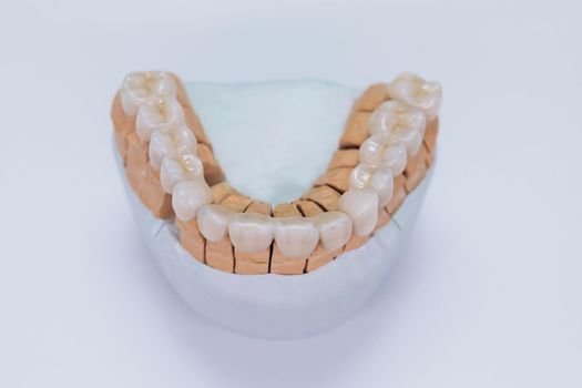 Ceramic tooth crown on plaster model. Finished new ceramic bridge veneers on plaster model. Dental veneers are lying on a wite background in the laboratory.