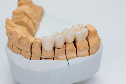 Metal ceramic bridge on a plaster model isolated on white background. Zirconium crowns veneers. Ceramic teeth with the veneers.