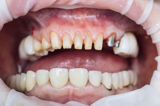 Dentistry Patient at the dentist office. Female teeth macro zirconium. Closeup photo with zirconium artificial teeth. Zirconia bridge with porcelain