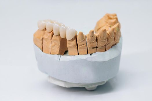 Metal free ceramic dental crowns on plaster model. Metal ceramic teeth and bridges.