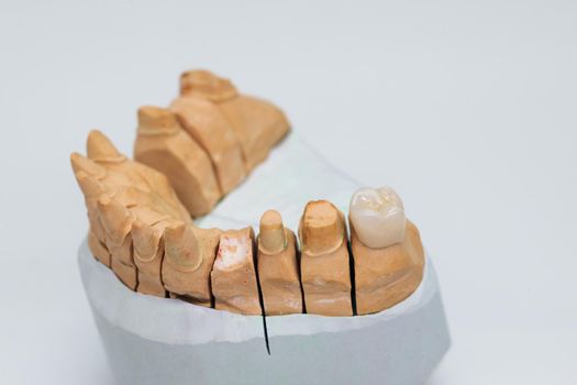 Metal free ceramic dental teeth. Ceramic veneers isolated on wite background. Metal-Ceramic crowns on gypsum model in dental laboratory.