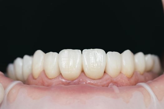 Dental health care. Ceramic zirconium in final version. Staining and glazing. Precision design and high quality materials.