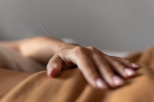 hand with acupuncture needle. High resolution photo