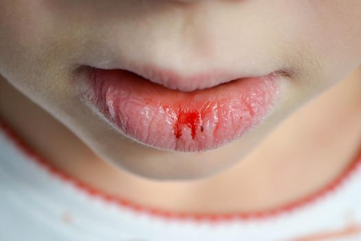 Dry and damaged lips of a girl. Close-up. Lip fissure and bleeding. Sick cracked damaged tissue. Dry lips with cracks, dry mouth, Closeup face with brittle and dry lips, dehydration High quality photo