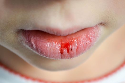 Dry and damaged lips of a girl. Close-up. Lip fissure and bleeding. Sick cracked damaged tissue. Dry lips with cracks, dry mouth, Closeup face with brittle and dry lips, dehydration High quality photo