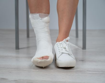 Close-up of female legs with plaster cast. A woman with a broken leg sits on a chair.