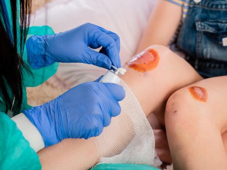 doctors hands in medical gloves apply antiseptic ointment on the open wound of the knee. close-up