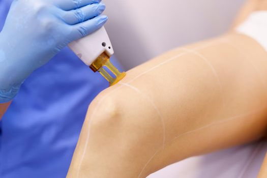 Woman receiving legs laser hair removal at a beauty center. Laser depilation treatment in an aesthetic clinic.