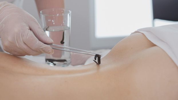 Non traditional medicine - doctor doing procedure of hirudotherapy for blonde young woman. Tibetan Medicine