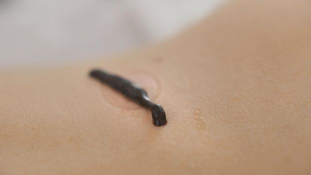 Hirudotherapy in clinic - Leech on skin of woman - close up view