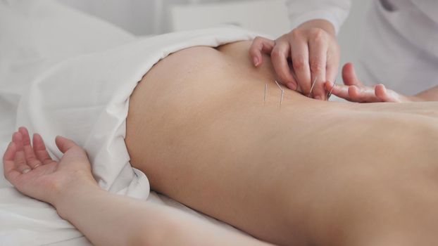 The doctor sticks needles into thegirl's body on the acupuncture, close-up