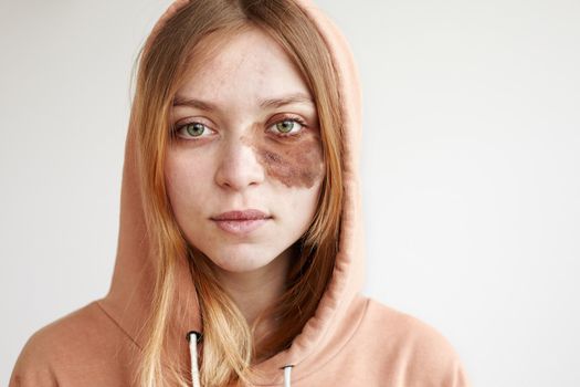 Crop young female looking at camera while standing in hoodie with brown nevus spot on cheek