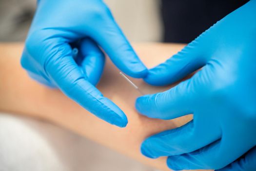 Close-up of a needle and hands of physiotherapist doing a dry needling in a physiotherapy center.