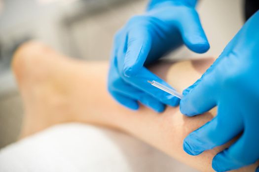 Close-up of a needle and hands of physiotherapist doing a dry needling in a physiotherapy center.