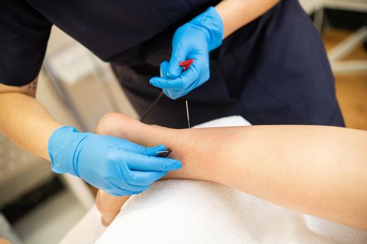 Electro-acupuncture dry with needle connecting machine. Electro stimulation in physical therapy.