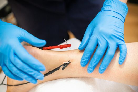 Electro-acupuncture dry with needle connecting machine. Electro stimulation in physical therapy.