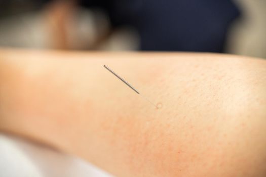 Close-up of a needle doing a dry needling in a physiotherapy center.