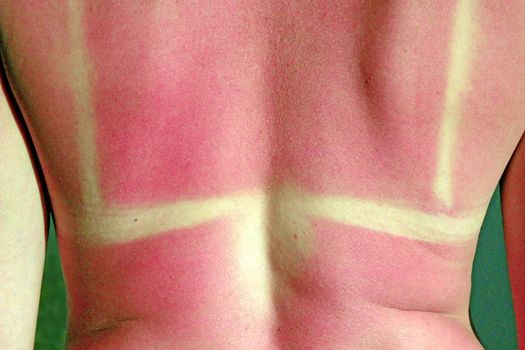 Human back burnt after sunburn. Scald of the back by sun's beams