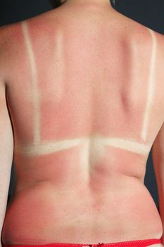 Human back burnt after sunburn. Scald of the back by sun's beams