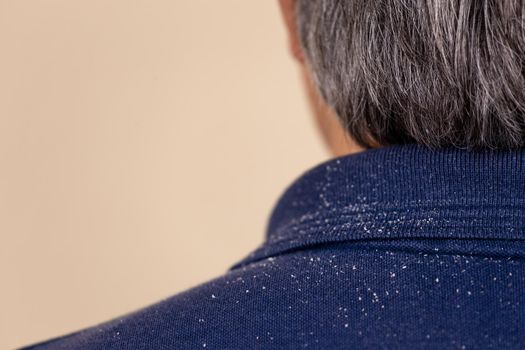 Close-up view of a man who has a lot of dandruff from his hair on his shirt and shoulders.