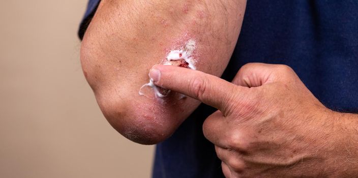 Concept photo of treatment of skin diseases using ointments as dosage form of drug. Patient causes medical therapeutic ointment thick consistency or cream moisturizer on skin in elbow area close-up.