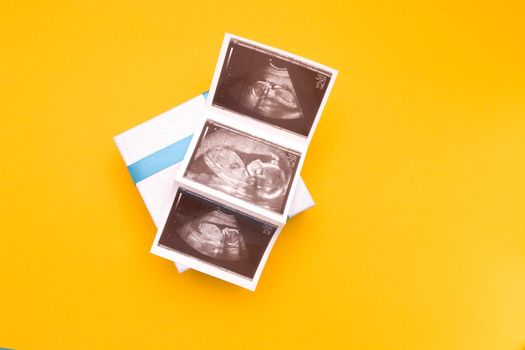 ultrasound picture in a silver box with a blue ribbon and yellow flower yellow background place copy top view, woman pregnant with boy or girl, surprise, photo as a gift, pregnancy concept