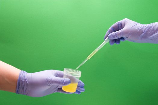 hand with a pipette and a hand with a jar for analysis, hands in disposable medical gloves, green background, copy space, drip from a pipette into a jar, draw urine into a pipette