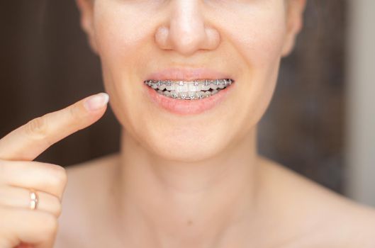 The girl points her finger at the even and white teeth with braces. Straightening your teeth with braces. Dental care. Smooth teeth and a beautiful smile