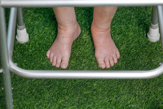 Elderly woman bare swollen feet on grass with walker