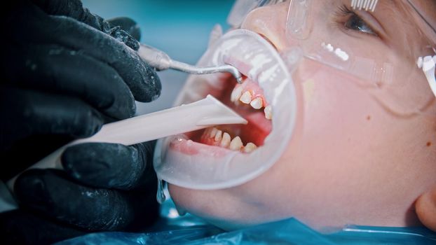 A little boy with baby teeth having a cleaning treatment in the dentistry. Mid shot