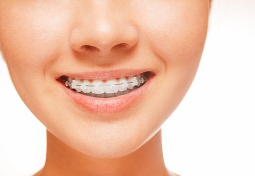 Woman smile: teeth with braces, dental care concept, front view