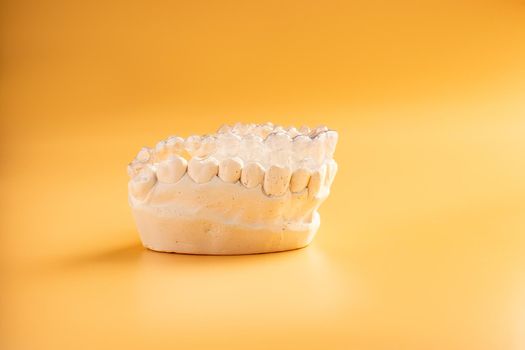 Inivisalign braces or aligner. A way to have a beautiful smile and white teeth.Invisible Invisalign plastic dental teeth brackets