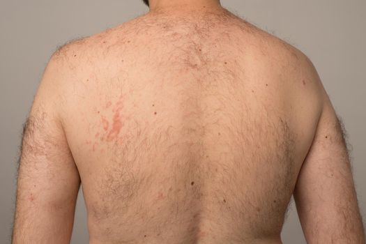 Allergy reaction is red spots on the body of a young man. Urticaria