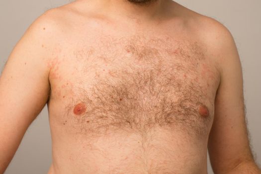 Allergy reaction is red spots on the body of a young man. Urticaria