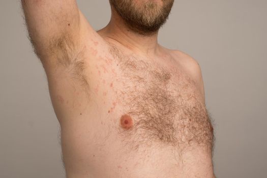 Allergy reaction is red spots on the body of a young man. Urticaria