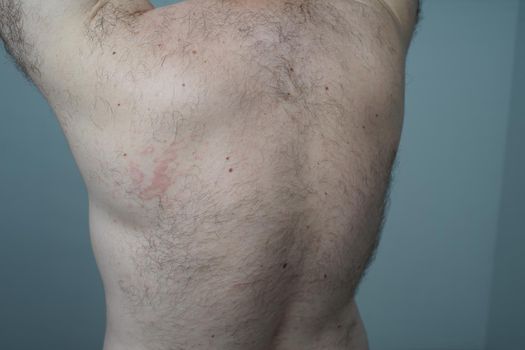 Allergy reaction is red spots on the body of a young man. Urticaria