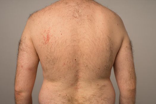 Allergy reaction is red spots on the body of a young man. Urticaria