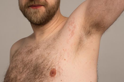 Allergy reaction is red spots on the body of a young man. Urticaria