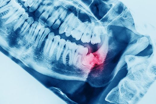 X-ray oral image with an inflamed wisdom tooth close-up.