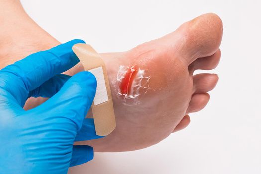 Doctor's hand in a protective medical glove seals the wound on the foot, woman's leg with a plaster on a white background, close-up.