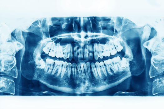X-ray image of oral cavity with growing lower wisdom teeth on white background.