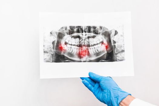 Doctor's hand in protective medical glove hold and examining an x-ray picture of teeth on a white background.