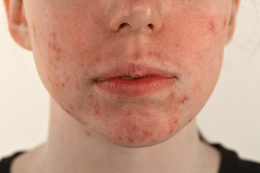 post-acne, scars and red festering pimples on the face of a young woman. concept of skin problems and harmonic failure - image